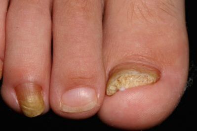 Micosis vun Neel op de Been
