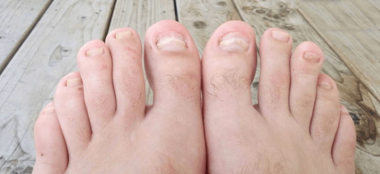 Nail filgus