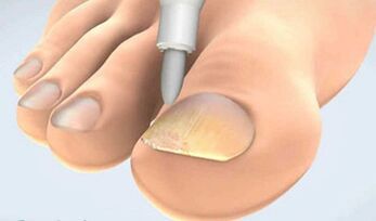 Onychomycosis Schrauwen Kollektioun