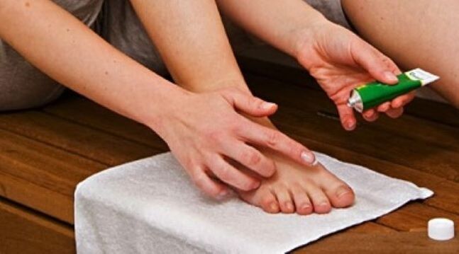 Behandlung vun Zehennagelpilz mat Salbe